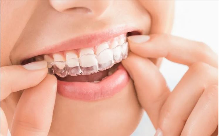 Invisible Braces in Dubai